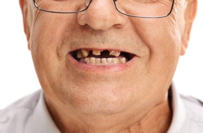 Causas de la pérdida dental