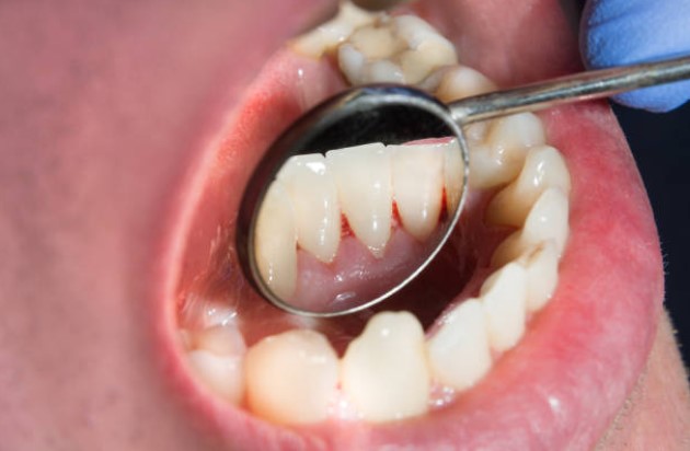 Cómo prevenir el cáncer oral
