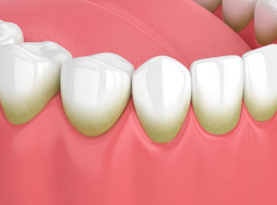 El papel de la placa en la infección periodontal