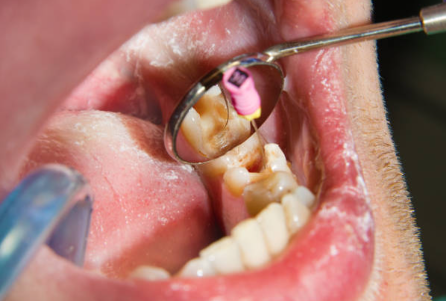 Objetivos de una endodoncia