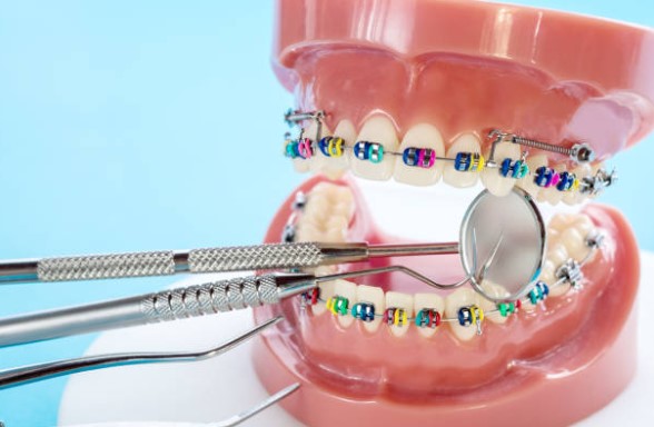 La edad ideal para realizar una ortodoncia