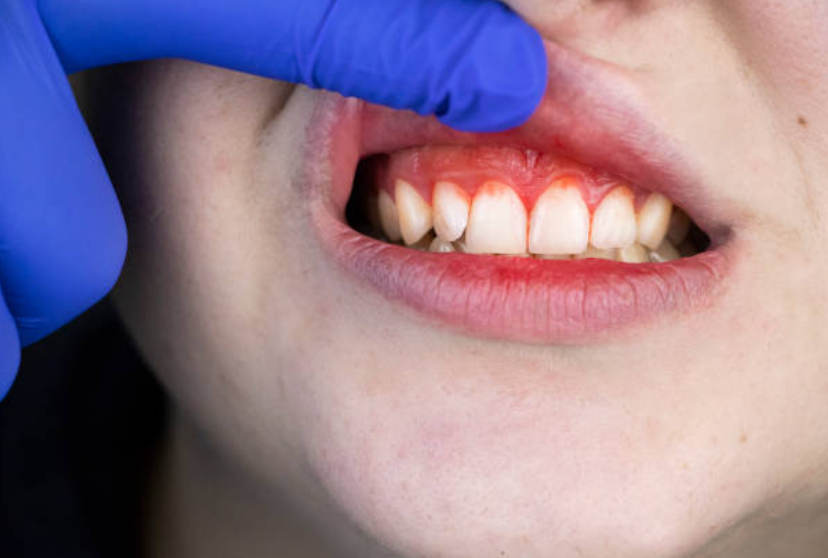 Cómo puede afectar la gingivitis a tu salud bucal