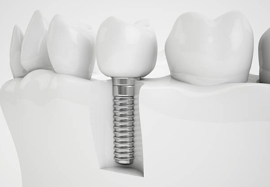El omeoprazol y los implantes dentales
