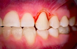 Gingivitis o periodontitis