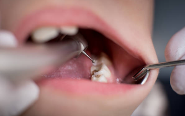 Caries Dental – Empastes Dentales