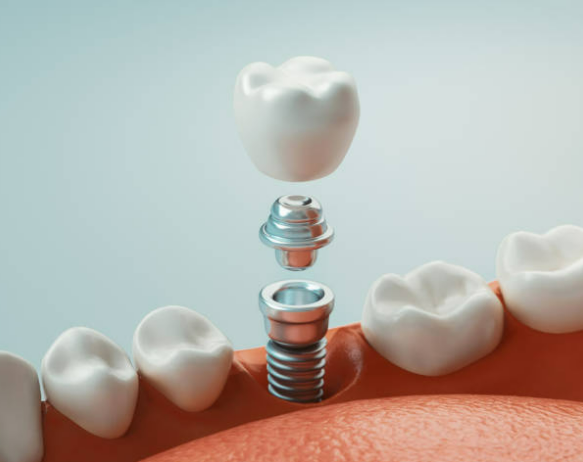 Implantes dentales a cualquier edad