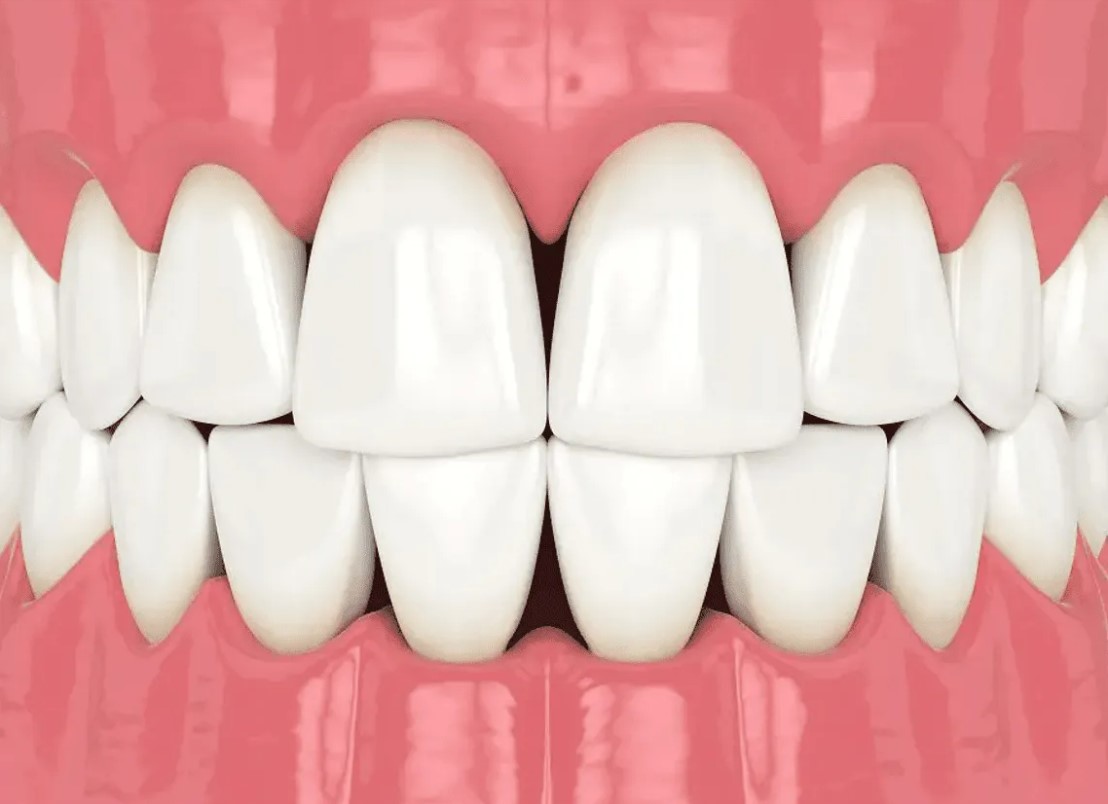 Troneras dentales