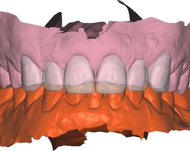 prótesis dental madrid