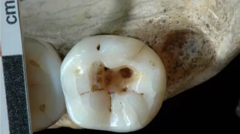dentistas prehistoria
